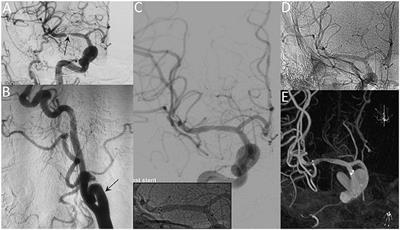 Weighing in on the Off-Label Use: Initial Experience of Neuroform EZ Stenting for Intracranial Arterial Stenosis in 45 Patients